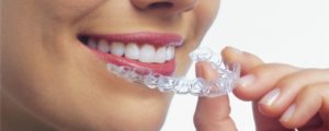 Ingen skæve tænder med invisalign
